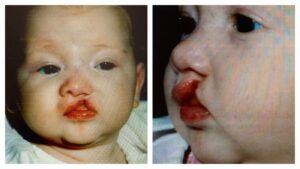 Two close-up photos of an infant are shown side by side. The baby has a cleft in their lip.